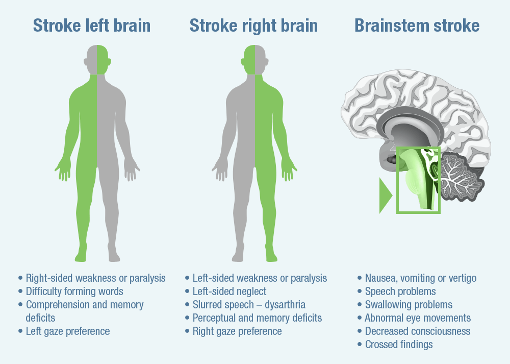 Why Strokes Can Happen At Any Age And How To Prevent Them