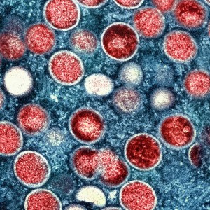 mpox-uk-preparing-after-virus-declared-global-emergency-as-sweden-records-first-case
