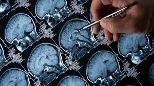 Pioneering Alzheimer's Drug Rejected for Widespread Use in NHS in England