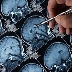 pioneering-alzheimers-drug-rejected-for-widespread-use-in-nhs-in-england