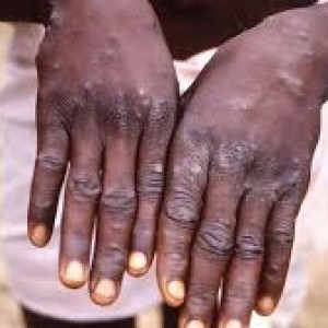 Mpox: More Cases of New Clade 1b Strain Detected in the UK